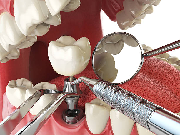 Best Emergency Dental Care for Broken or Chipped Teeth in South Valley, NM