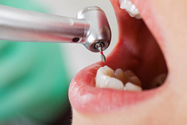 Best Emergency Dental Care for Broken or Chipped Teeth in South Valley, NM